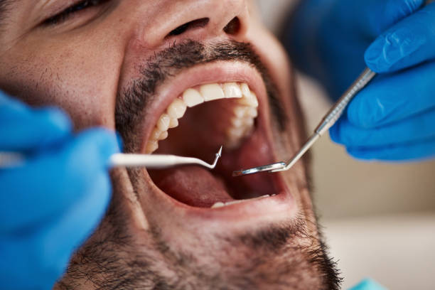 Best Emergency Treatment for Oral Infections in York, AL